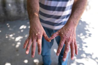 Porto Alegre confirma 1º caso de mpox em 2026 e faz alerta no Carnaval: ‘Evitar contato Porto Alegre confirma 1º caso de mpox em 2026 e faz alerta no Carnaval: ‘Evitar contato